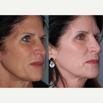 45-54 year old woman treated with Fraxel Laser after 3642888