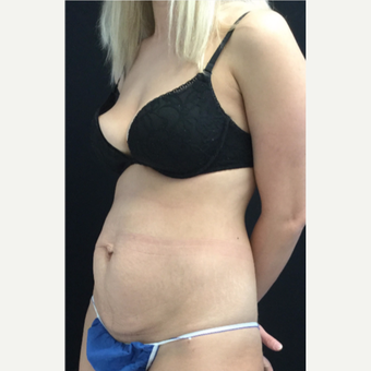 25-34 year old woman treated with Tummy Tuck before 3219070
