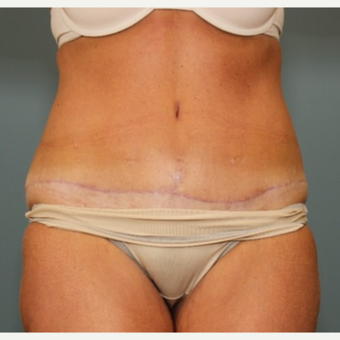 45-54 year old woman requesting a Tummy Tuck Revision after 3031533