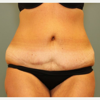 45-54 year old woman requesting a Tummy Tuck Revision before 3031533
