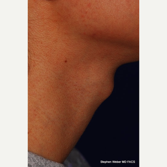 18-24 year old woman treated with Adam's Apple Reduction before 3624532