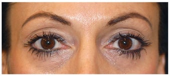 Eye Area Rejuvenation before 1181545