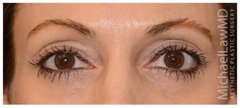 Eye Area Rejuvenation after 1181545