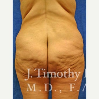 Body Lift 1652576