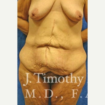 Body Lift before 1652576
