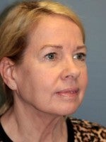 55-64 year old woman treated with Neck Lift before 3103904