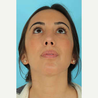 25-34 year old woman treated with Rhinoplasty after 3691152