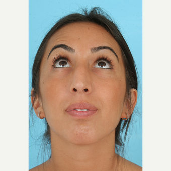25-34 year old woman treated with Rhinoplasty before 3691152