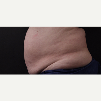 59 year old woman treated with CoolSculpting before 3384610
