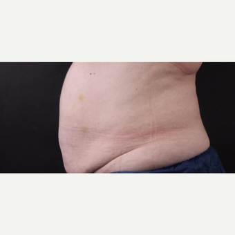 59 year old woman treated with CoolSculpting after 3384610