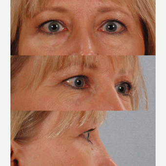 Eyelid Surgery before 3123765