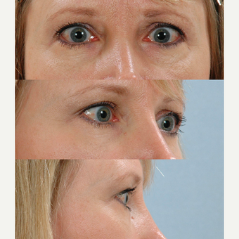 Eyelid Surgery after 3123765