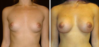 28 year old female, breast augmentation before 628316