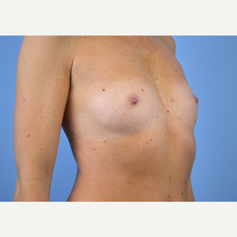 25-34 year old woman treated with Breast Implants before 3440034