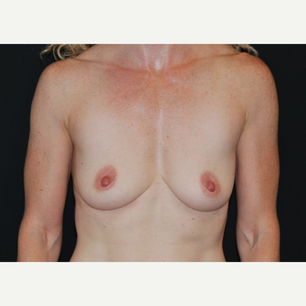 35-44 year old woman treated with Breast Implants before 3651331