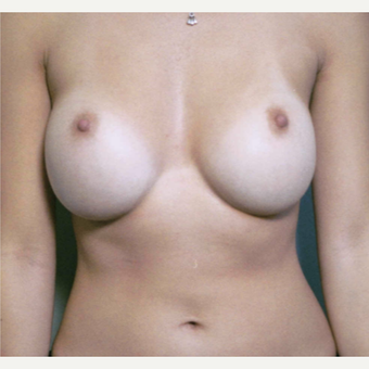 35-44 year old woman treated with Breast Implant Revision before 3153967