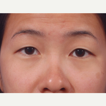 29 year old woman treated with Asian Eyelid Surgery (Double eyelid) before 3803240