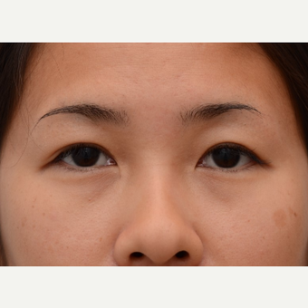 29 year old woman treated with Asian Eyelid Surgery (Double eyelid) after 3803240
