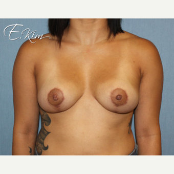 25-34 year old woman treated with Breast Lift after 3663328