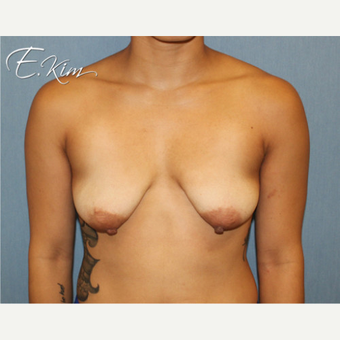 25-34 year old woman treated with Breast Lift before 3663328
