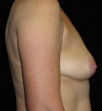 45 year old woman treated with Breast Lift with Implants 3252376