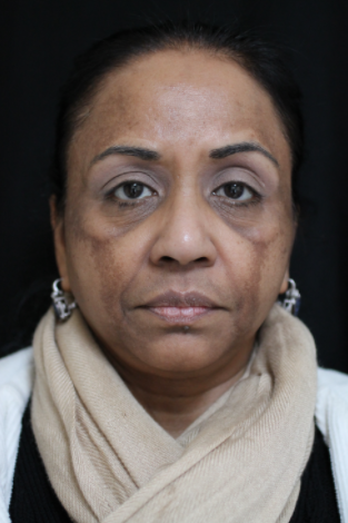 55-64 year old woman treated with Chemical Peel before 2249180