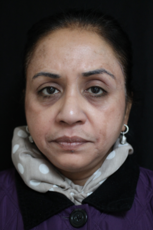 55-64 year old woman treated with Chemical Peel after 2249180