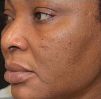 45-54 year old woman treated with Scars Treatment before 1556989