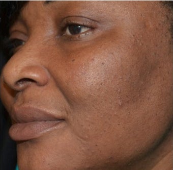 45-54 year old woman treated with Scars Treatment after 1556989