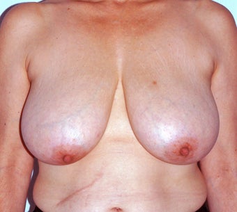periareolar circular scar breast reduction before 1275703