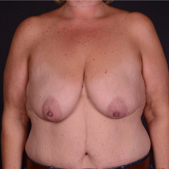 45-54 year old woman treated with Breast Lift with Implants before 3738114