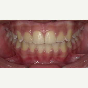 17 or under year old woman treated with Braces after 3663430