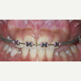 17 or under year old woman treated with Braces before 3663430