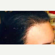 25-34 year old woman treated with Hair Transplant after 2681573