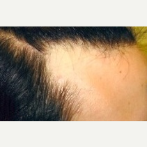 25-34 year old woman treated with Hair Transplant before 2681573