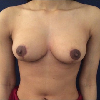 24 year old woman treated with Breast Reduction after 1926338