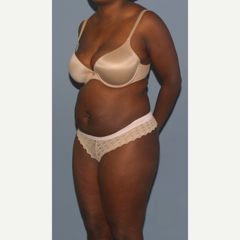 35-44 year old woman treated with Tummy Tuck before 3512761