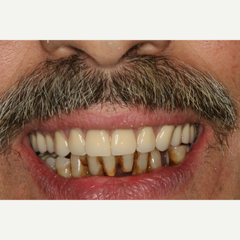 55-64 year old man treated with 6 immediate load Dental Implants after 3541525