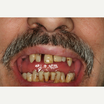 55-64 year old man treated with 6 immediate load Dental Implants before 3541525