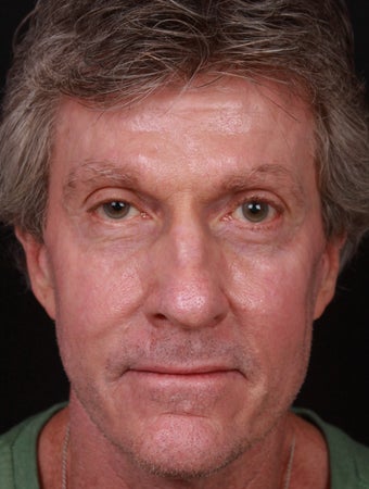 VBeam for Veins and Redness after 1358649