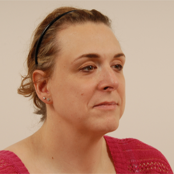 42 year old transgender woman underwent Facial Feminization Surgery. before 3108798