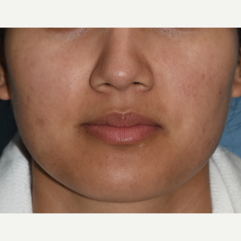 25-34 year old woman treated with Buccal Fat Removal before 3234424