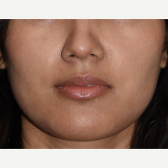 25-34 year old woman treated with Buccal Fat Removal after 3234424