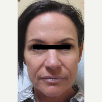 45-54 year old woman treated with Liquid Facelift (Juvederm Ultra Plus, Voluma & Dysport) before 3197762