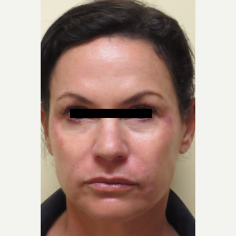 45-54 year old woman treated with Liquid Facelift (Juvederm Ultra Plus, Voluma & Dysport) after 3197762