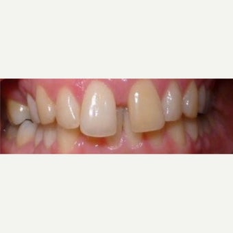 Dental Braces before 2651303