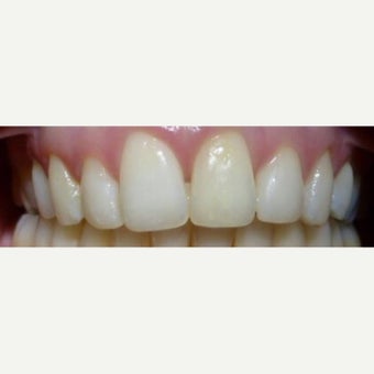 Dental Braces after 2651303