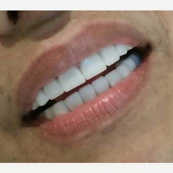 55-64 year old woman treated with Dental Implants after 3221066