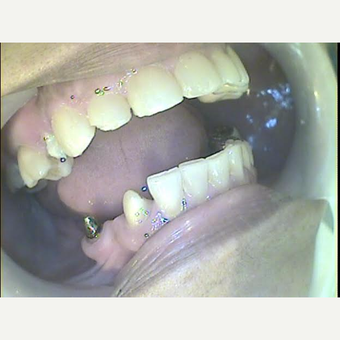 55-64 year old woman treated with Dental Implants before 3221066