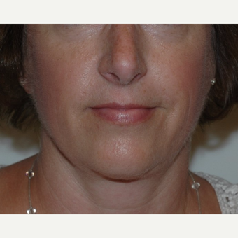 Liposuction after 3345878
